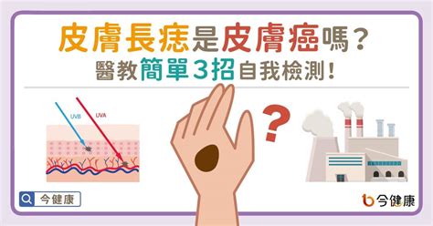 屁股長黑痣|皮膚長痣是皮膚癌嗎？醫教簡單3招自我檢測！